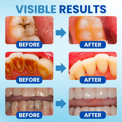 🌟 Official Store | 🛡️ Rebuild Enamel With Postbiotics Science! Anti-Plaque Oral Serum